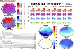 Beyin Haritalaması - Kantitatif EEG/ QEEG 48