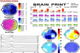 Beyin Haritalaması - Kantitatif EEG/ QEEG 49