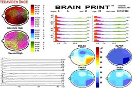 Beyin Haritalaması - Kantitatif EEG/ QEEG 52