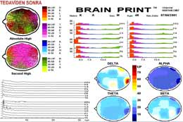 Beyin Haritalaması - Kantitatif EEG/ QEEG 53