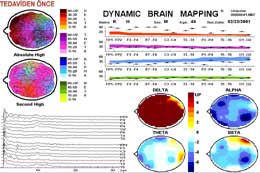 Beyin Haritalaması - Kantitatif EEG/ QEEG 50