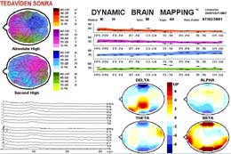 Beyin Haritalaması - Kantitatif EEG/ QEEG 51