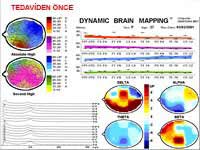 Beyin Haritalaması - Kantitatif EEG/ QEEG 7