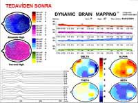 Beyin Haritalaması - Kantitatif EEG/ QEEG 8