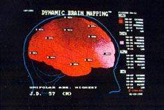 Beyin Haritalaması - Kantitatif EEG/ QEEG 44