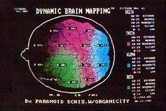 Beyin Haritalaması - Kantitatif EEG/ QEEG 46