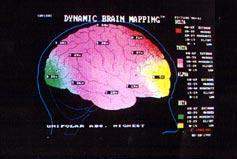 Beyin Haritalaması - Kantitatif EEG/ QEEG 47