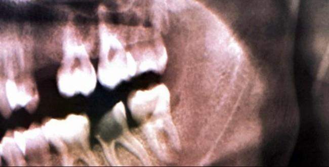 6500 yıllık diş dolgusu bulundu