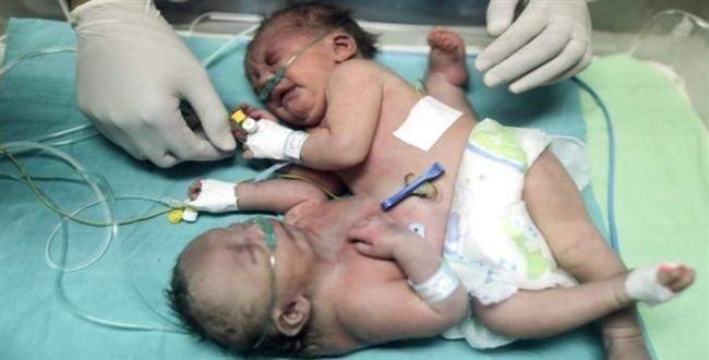 Yapışık ikizler Gazze dışında tedavi edilmeli