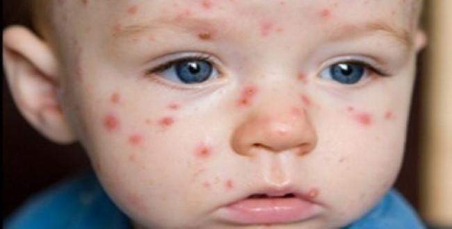 Çocuklarda alerji gitgide artıyor! Neden?