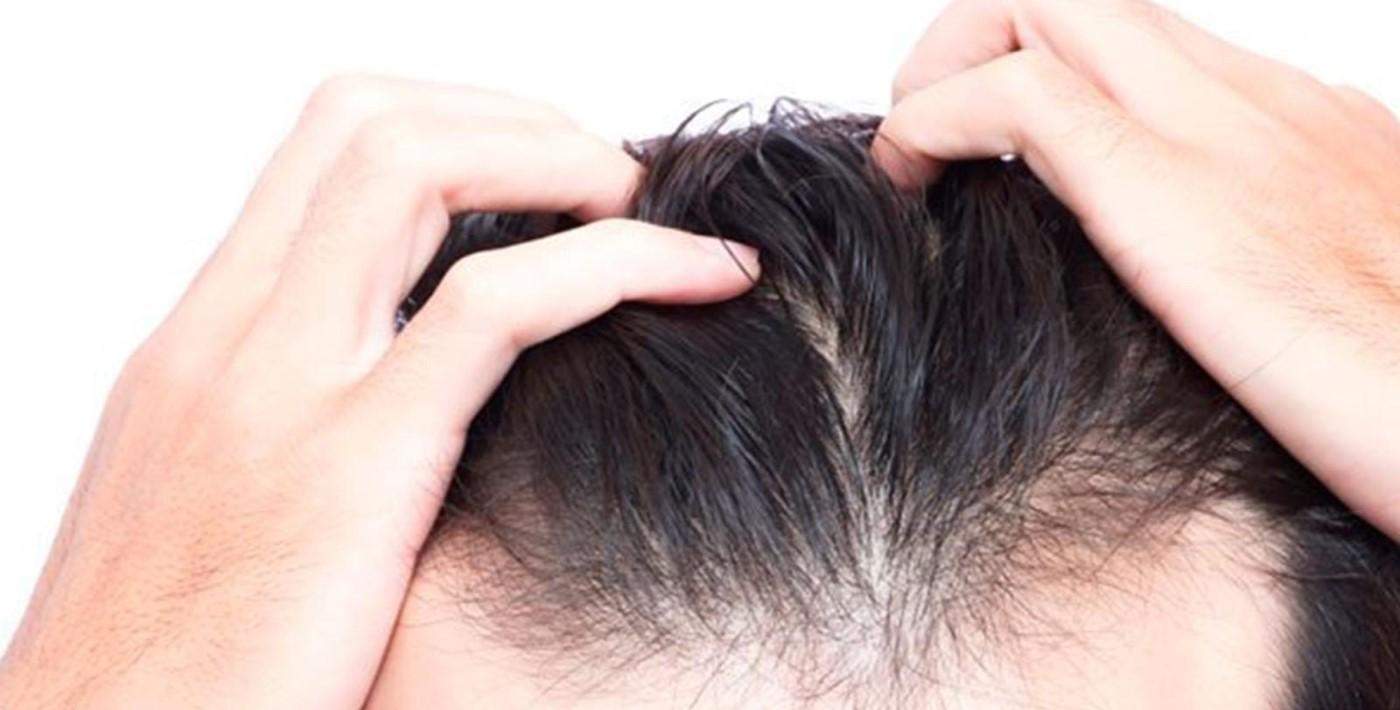 Erkeklerde Saç Dökülmesi: Tedaviler ve Çözümler