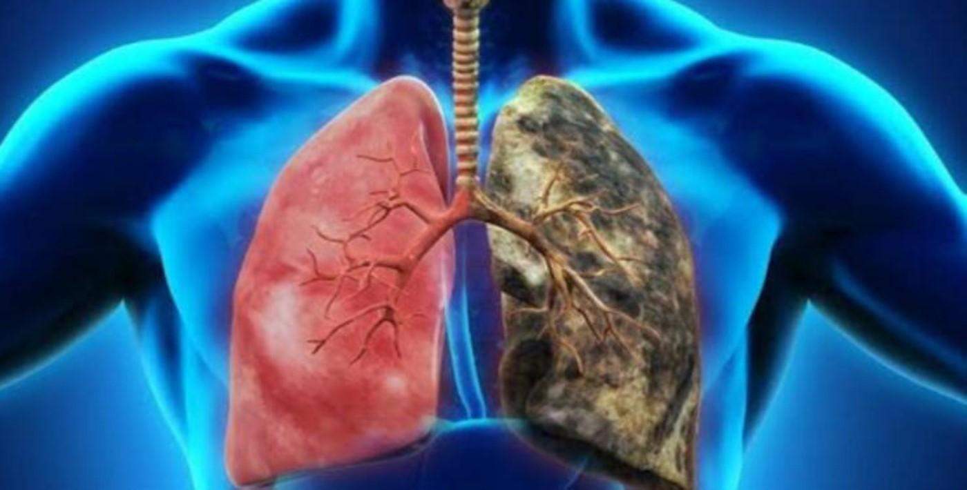 Kronik obstrüktif akciğer hastalığı (KOAH) nedir?
