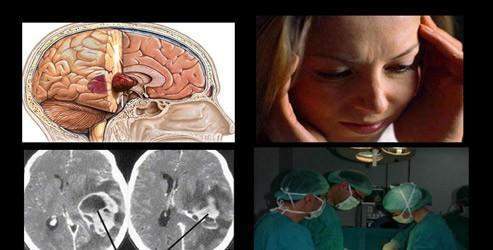 Beyin tümörü ameliyatlarında 3 boyutlu görüntüleme