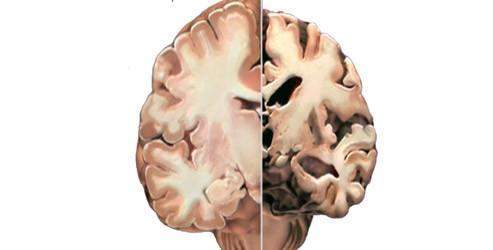Büyük hedefler Alzheimer'a bağlı rahatsızlıkları önleyebilir