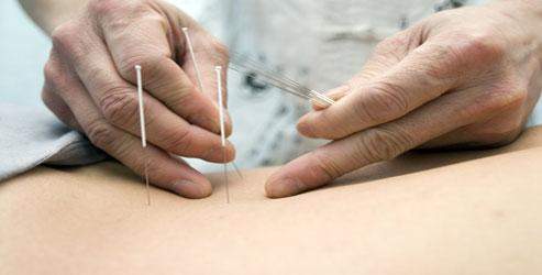 Akupunktur 70 hastalığın tedavisinde etkili