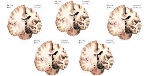 2050 yılında üç misli Alzheimer hastası