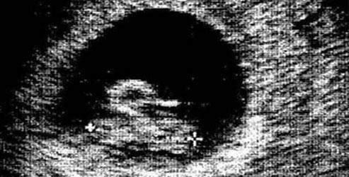 Kalp krizi geçirten ultrason fotoğrafları
